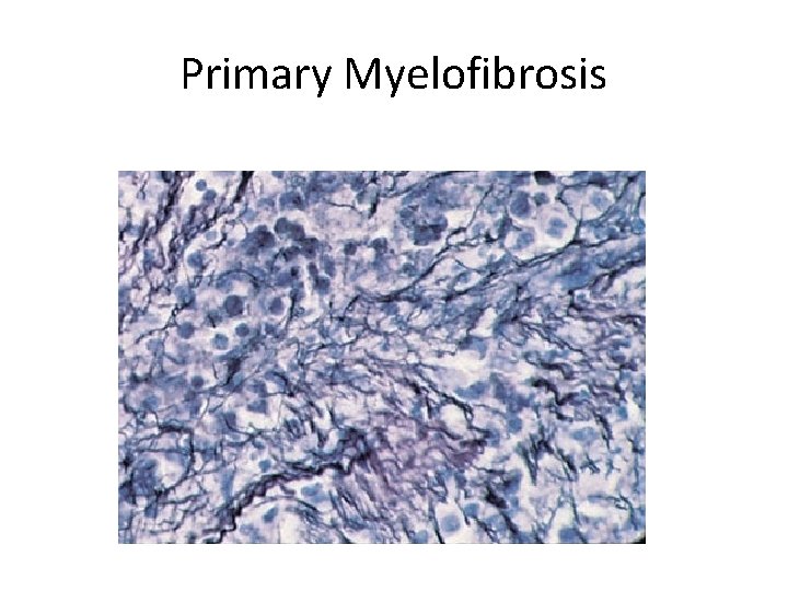 Primary Myelofibrosis 