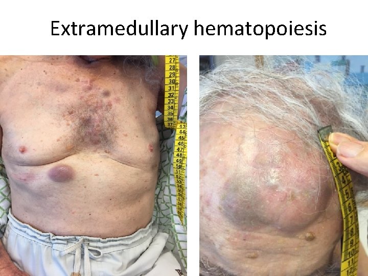 Extramedullary hematopoiesis 