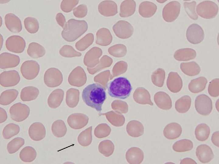 WHO 2014 Diagnostic Criteria Major criteria • Megakaryocyte proliferation and atypia accompanied by fibrosis