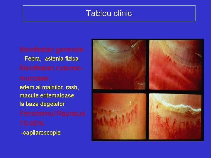 Tablou clinic Manifestari generale: Febra, astenia fizica Manifestari cutaneomucoase: edem al mainilor, rash, macule