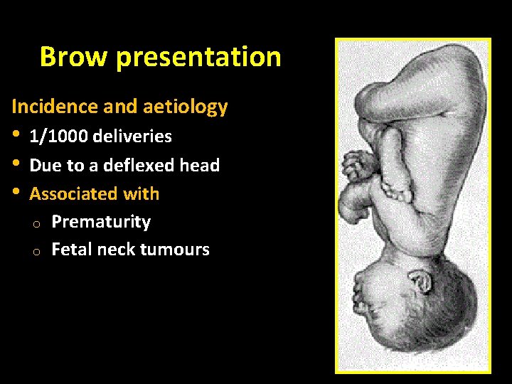 Brow presentation Incidence and aetiology • • • 1/1000 deliveries Due to a deflexed