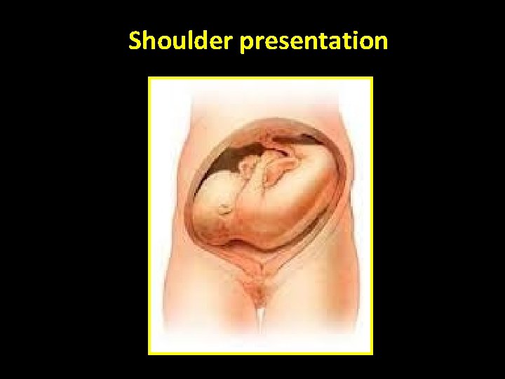 Shoulder presentation 