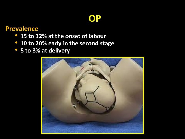 Prevalence • • • OP 15 to 32% at the onset of labour 10