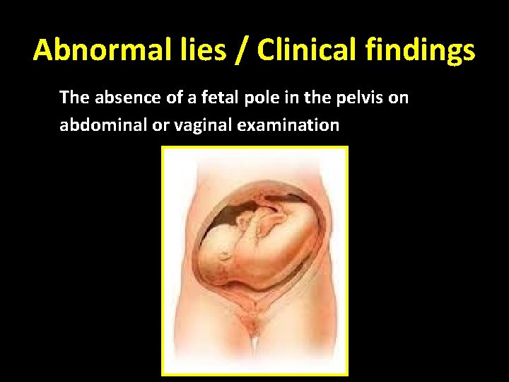 Abnormal lies / Clinical findings The absence of a fetal pole in the pelvis