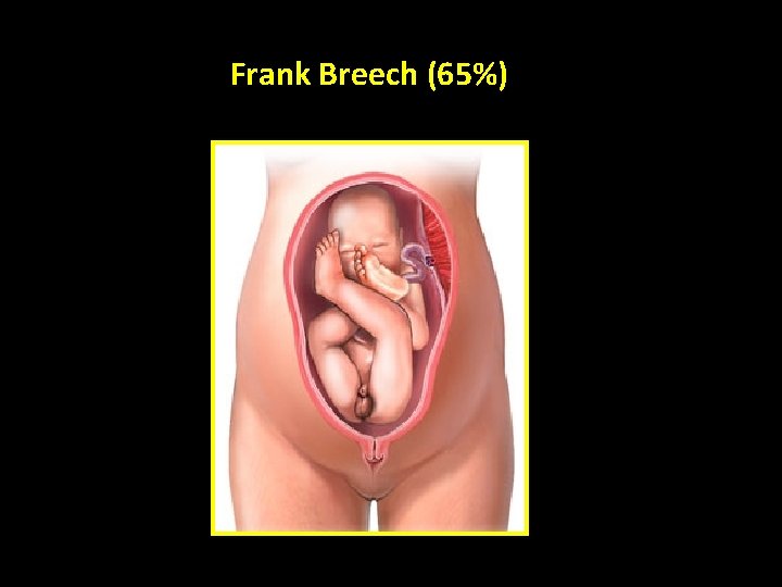 Frank Breech (65%) 