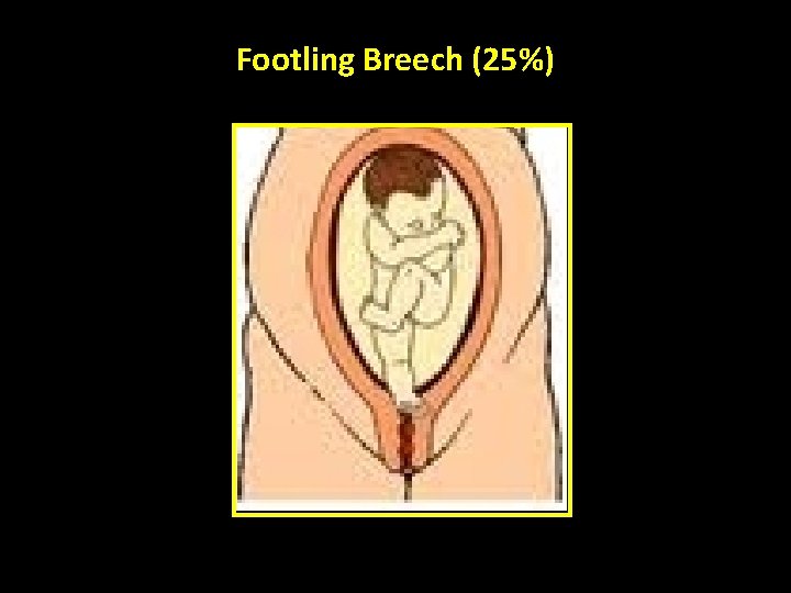Footling Breech (25%) 