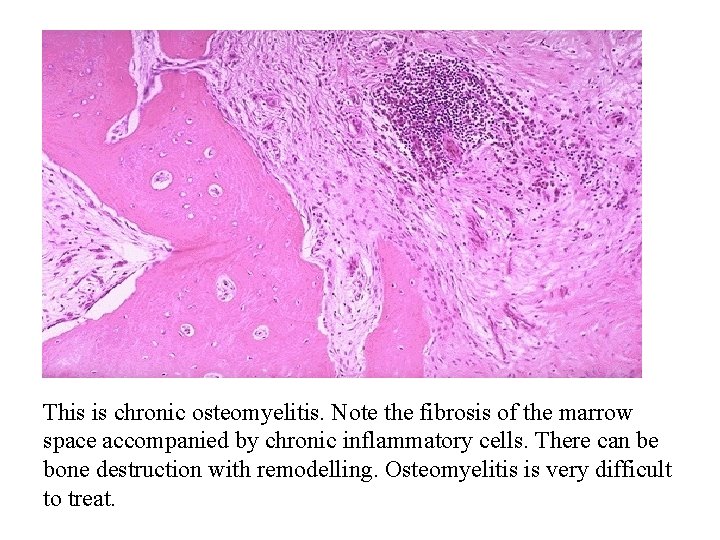 This is chronic osteomyelitis. Note the fibrosis of the marrow space accompanied by chronic