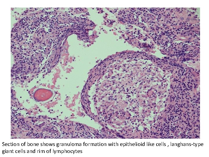 Section of bone shows granuloma formation with epithelioid like cells , langhans-type giant cells