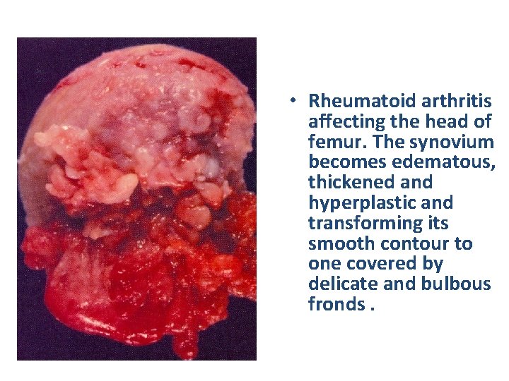  • Rheumatoid arthritis affecting the head of femur. The synovium becomes edematous, thickened