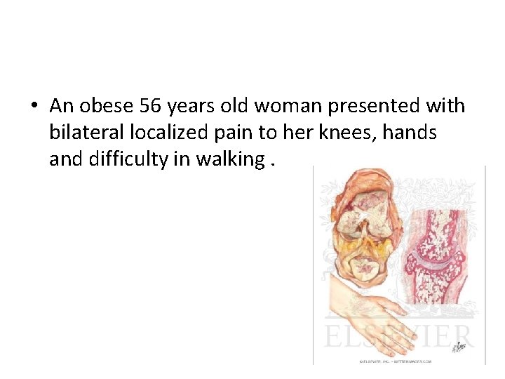  • An obese 56 years old woman presented with bilateral localized pain to