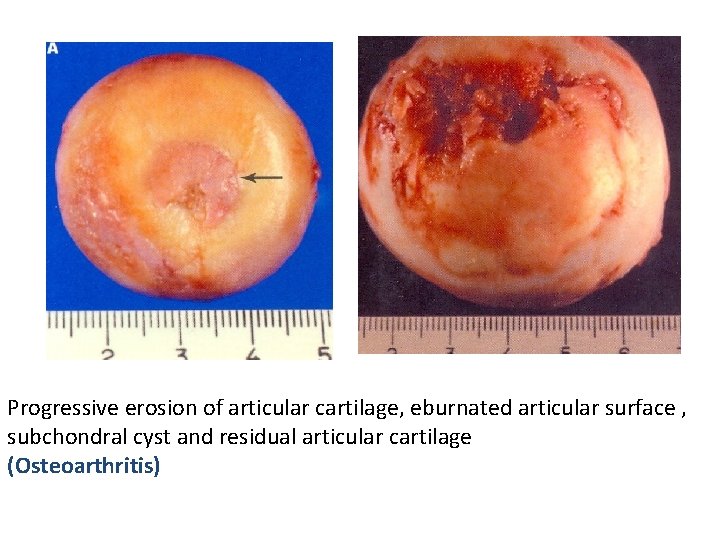 Progressive erosion of articular cartilage, eburnated articular surface , subchondral cyst and residual articular