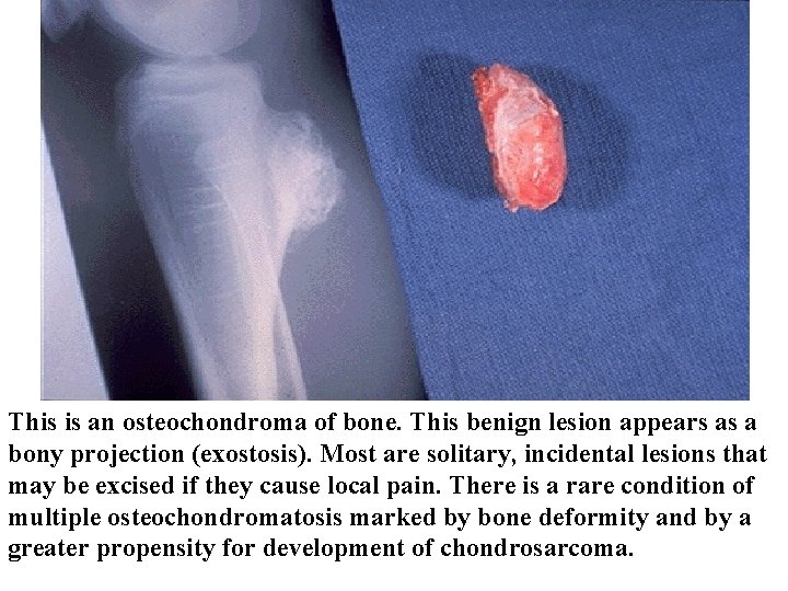 This is an osteochondroma of bone. This benign lesion appears as a bony projection