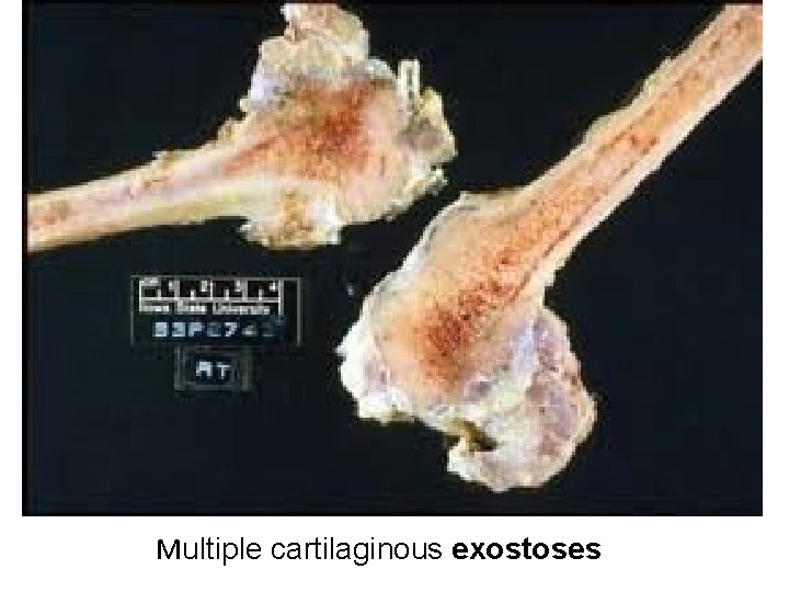 Multiple cartilaginous exostoses 