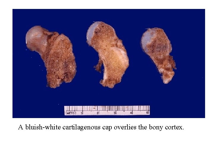 A bluish-white cartilagenous cap overlies the bony cortex. 