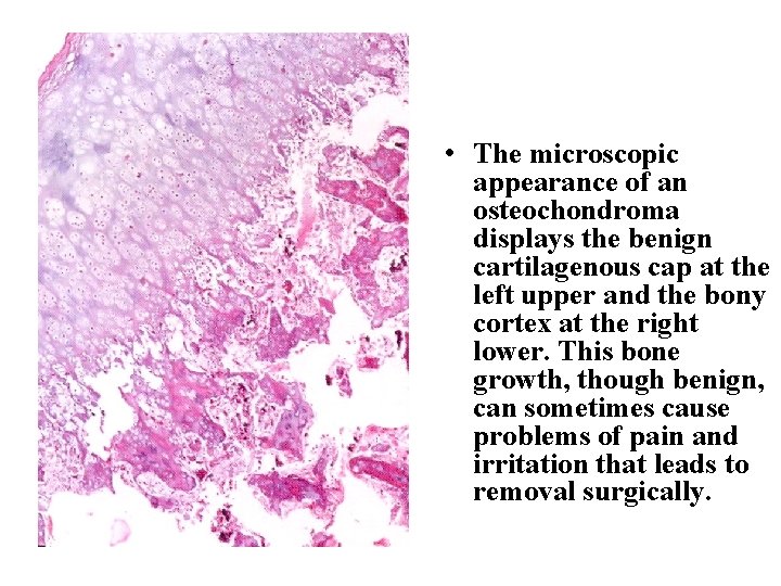  • The microscopic appearance of an osteochondroma displays the benign cartilagenous cap at