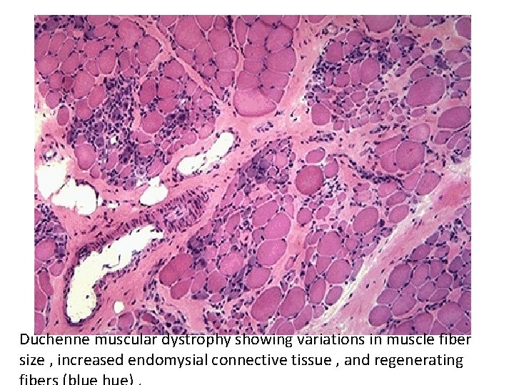 Duchenne muscular dystrophy showing variations in muscle fiber size , increased endomysial connective tissue