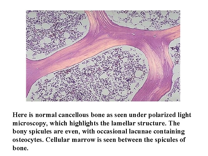 Here is normal cancellous bone as seen under polarized light microscopy, which highlights the