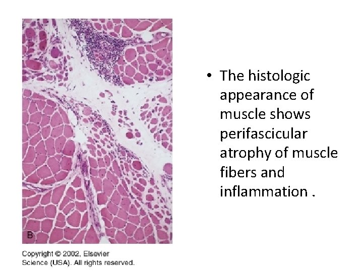  • The histologic appearance of muscle shows perifascicular atrophy of muscle fibers and