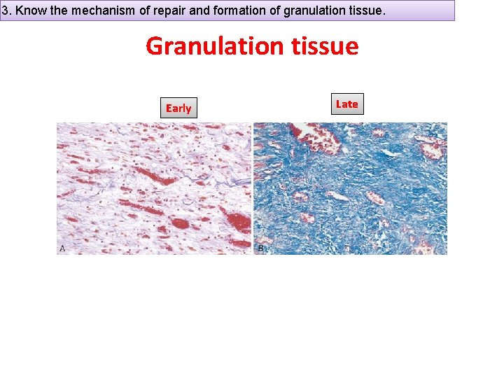 3. Know the mechanism of repair and formation of granulation tissue. Granulation tissue Early