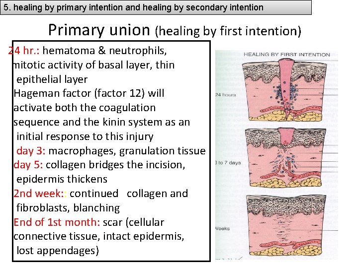 5. healing by primary intention and healing by secondary intention Primary union (healing by