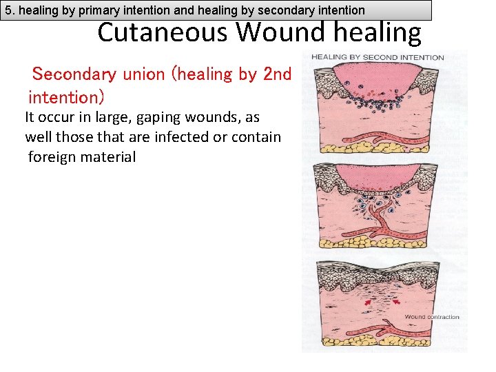 5. healing by primary intention and healing by secondary intention Cutaneous Wound healing Secondary