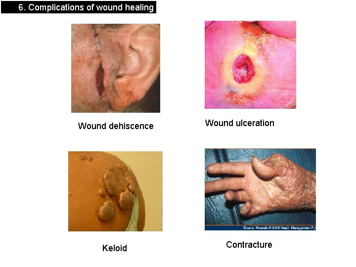 6. Complications of wound healing Wound dehiscence Keloid Wound ulceration Contracture 