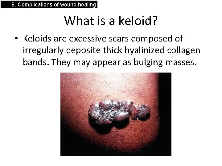 6. Complications of wound healing What is a keloid? • Keloids are excessive scars