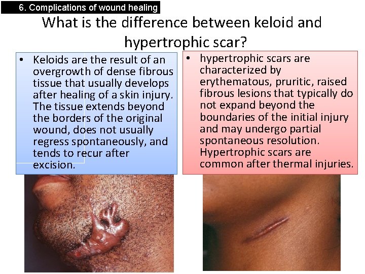 6. Complications of wound healing What is the difference between keloid and hypertrophic scar?