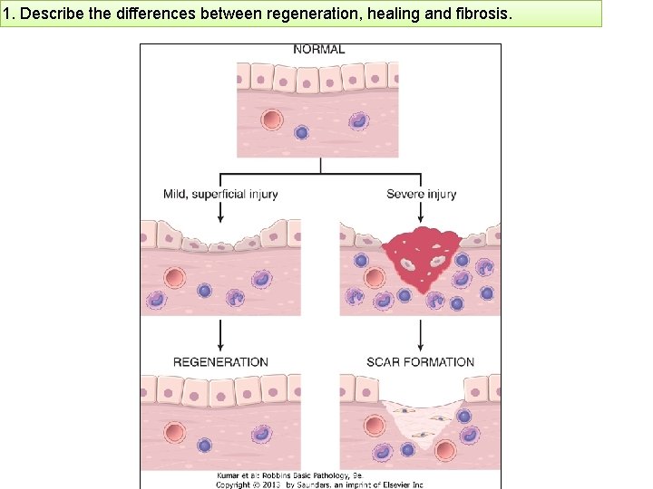 1. Describe the differences between regeneration, healing and fibrosis. 