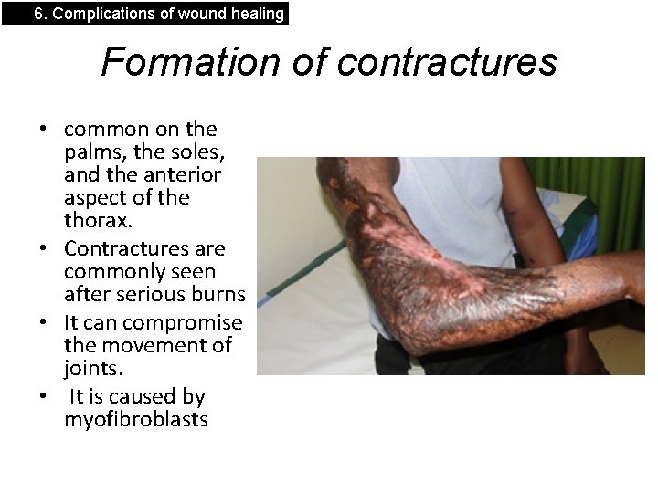 6. Complications of wound healing Formation of contractures • common on the palms, the