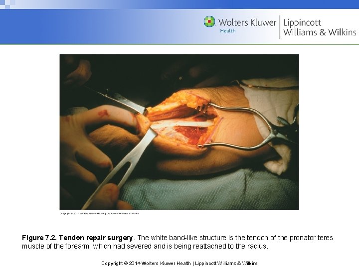 Figure 7. 2. Tendon repair surgery. The white band-like structure is the tendon of