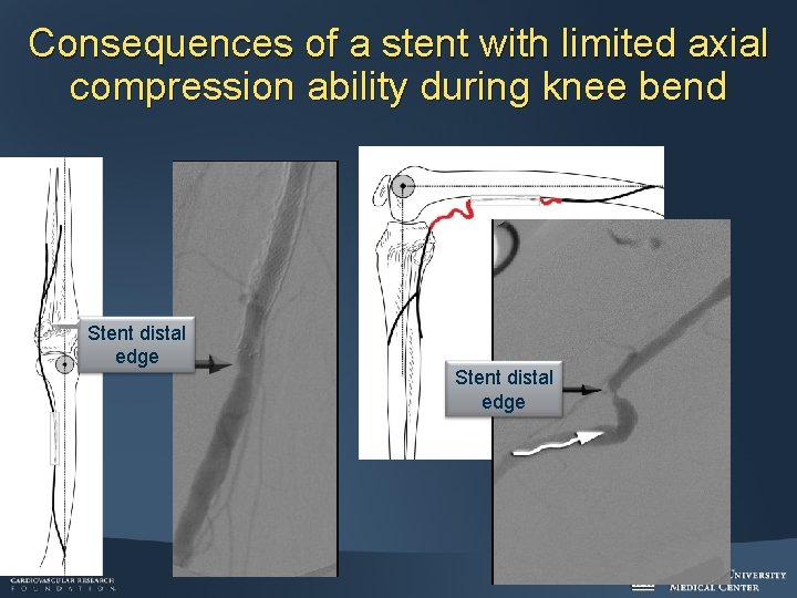 Consequences of a stent with limited axial compression ability during knee bend Stent distal