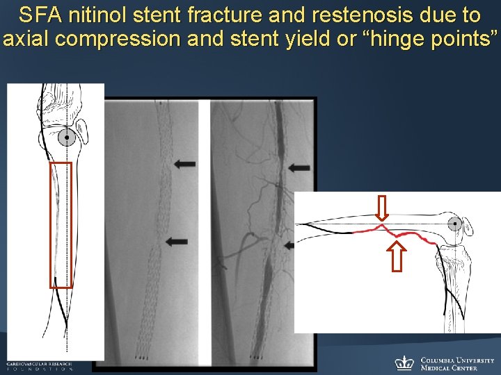 SFA nitinol stent fracture and restenosis due to axial compression and stent yield or