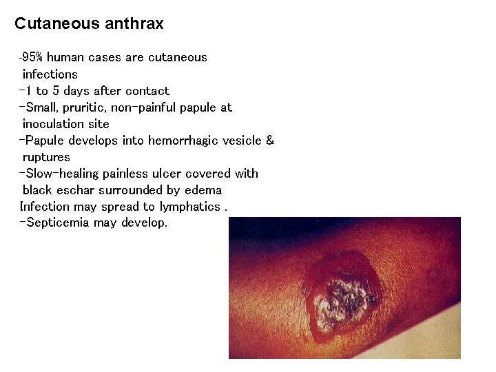 Cutaneous anthrax -95% human cases are cutaneous infections -1 to 5 days after contact