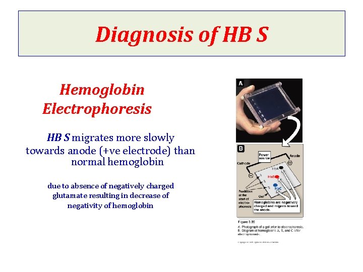 Diagnosis of HB S Hemoglobin Electrophoresis HB S migrates more slowly towards anode (+ve Diagnosis of HB S Hemoglobin Electrophoresis HB S migrates more slowly towards anode (+ve