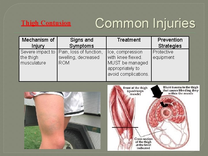 Thigh Contusion Mechanism of Injury Common Injuries Signs and Symptoms Severe impact to Pain,