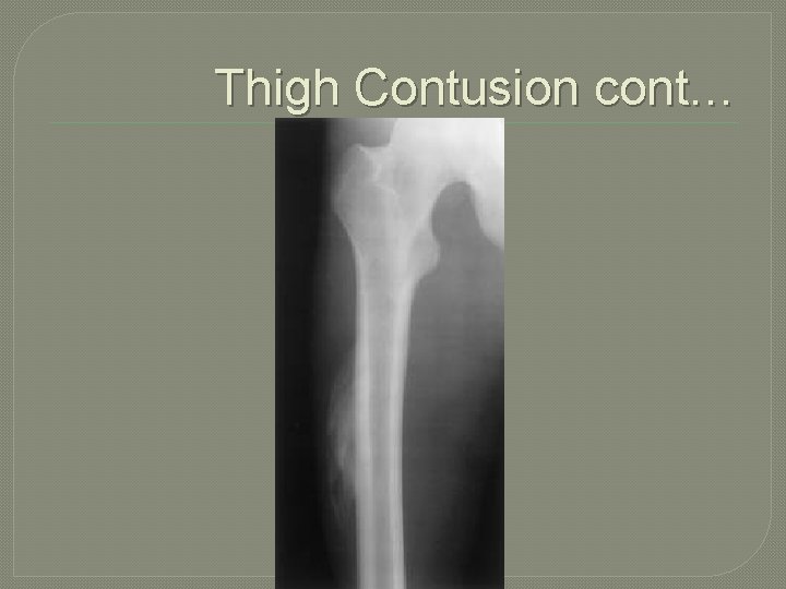 Thigh Contusion cont… 