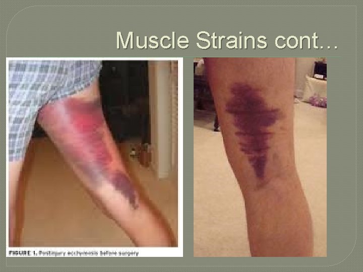 Muscle Strains cont… 