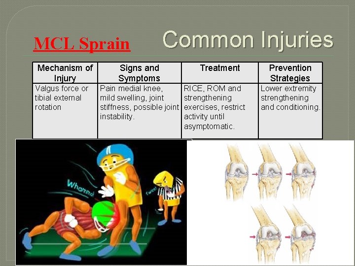 MCL Sprain Mechanism of Injury Valgus force or tibial external rotation Common Injuries Signs
