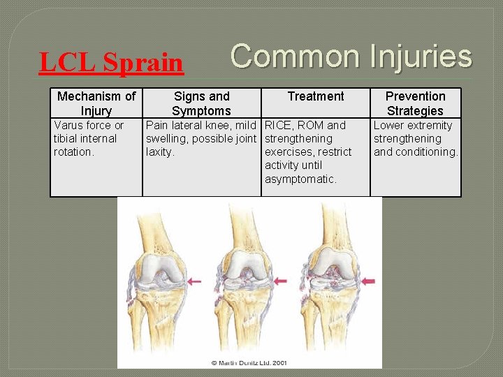 LCL Sprain Mechanism of Injury Varus force or tibial internal rotation. Common Injuries Signs