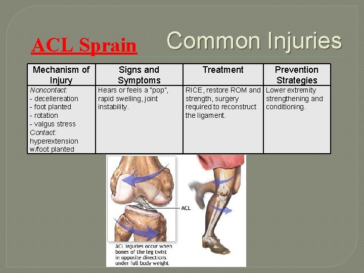 ACL Sprain Mechanism of Injury Noncontact: - decellereation - foot planted - rotation -