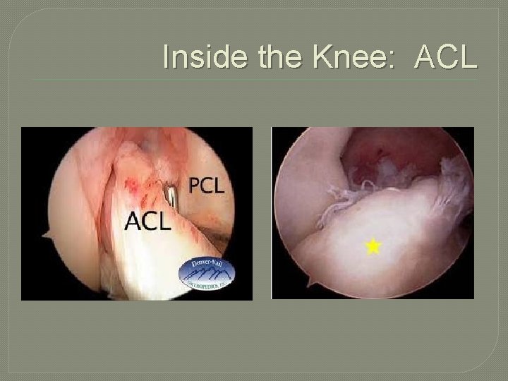 Inside the Knee: ACL 