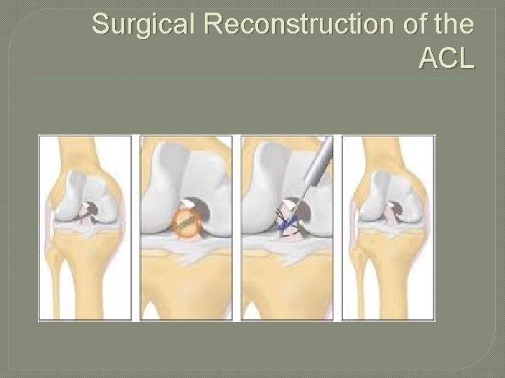 Surgical Reconstruction of the ACL 