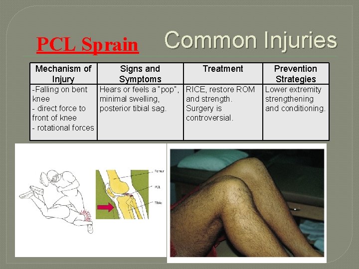 PCL Sprain Mechanism of Injury Common Injuries Signs and Symptoms -Falling on bent Hears
