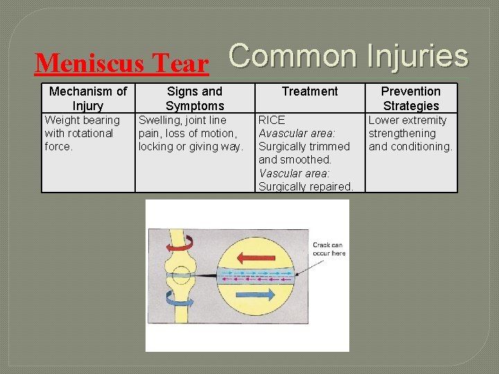Meniscus Tear Common Injuries Mechanism of Injury Weight bearing with rotational force. Signs and