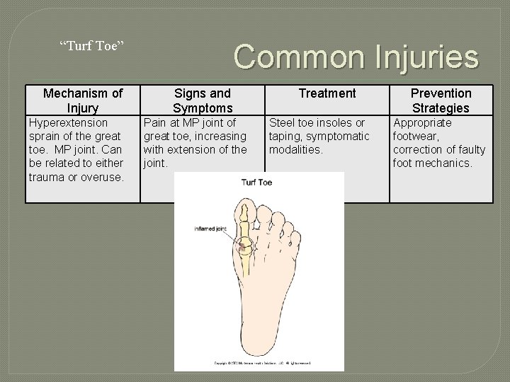 “Turf Toe” Mechanism of Injury Hyperextension sprain of the great toe. MP joint. Can