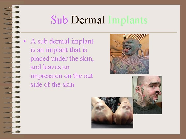 Sub Dermal Implants • A sub dermal implant is an implant that is placed