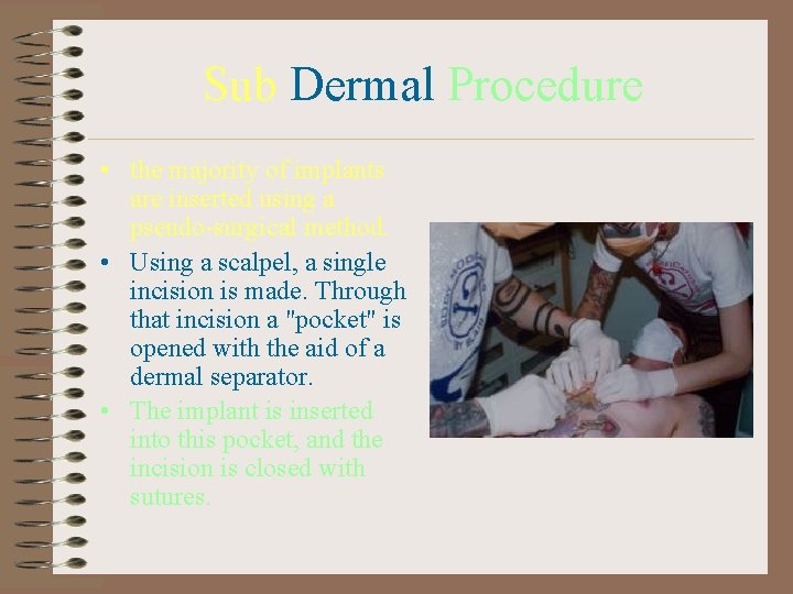 Sub Dermal Procedure • the majority of implants are inserted using a pseudo-surgical method.