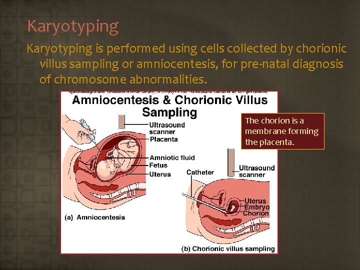 Karyotyping is performed using cells collected by chorionic villus sampling or amniocentesis, for pre-natal