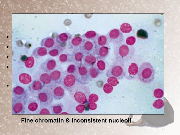 Cytology • • FNA of adrenal masses is not recommended Amy adrenal tumor has